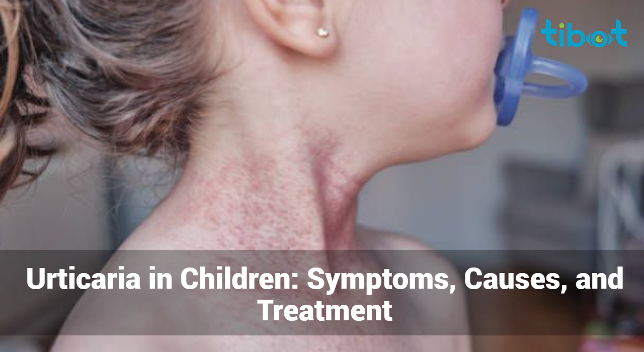 Urticaria-in-Children