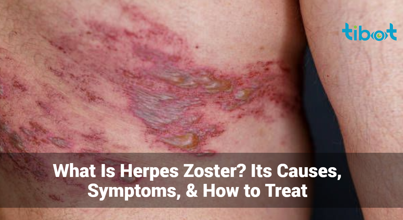 What-Is-Herpes-Zoster