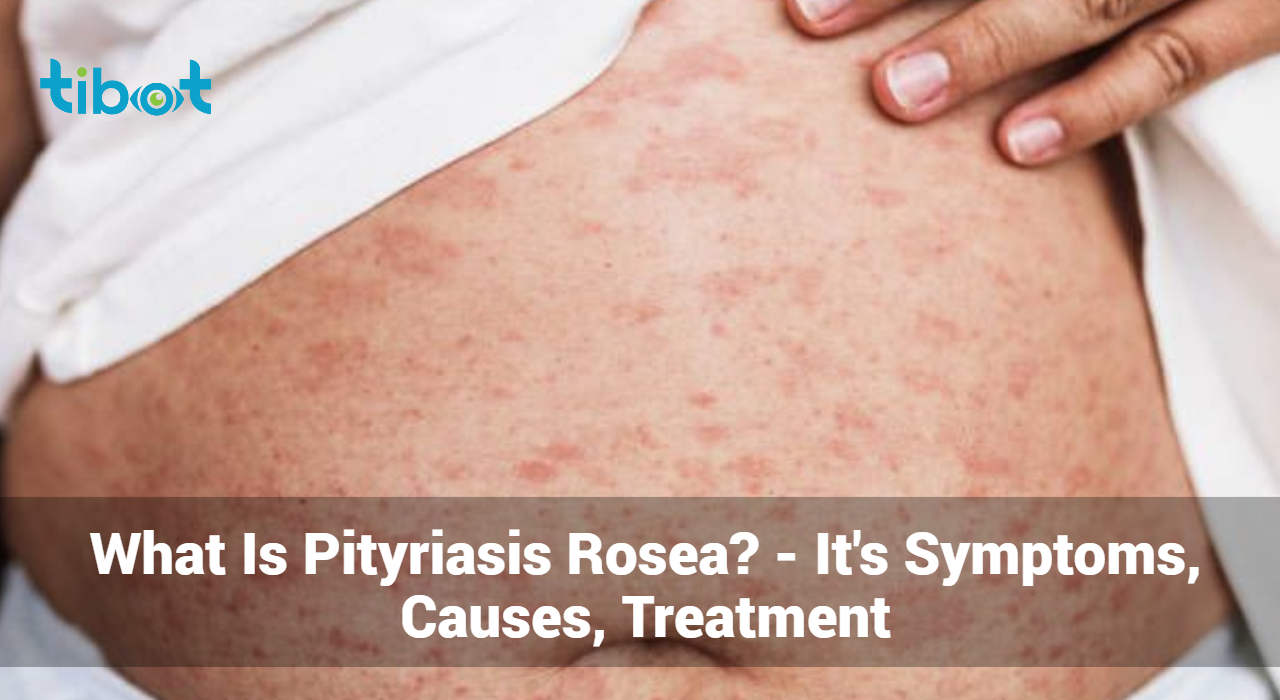 What-Is-Pityriasis-Rosea