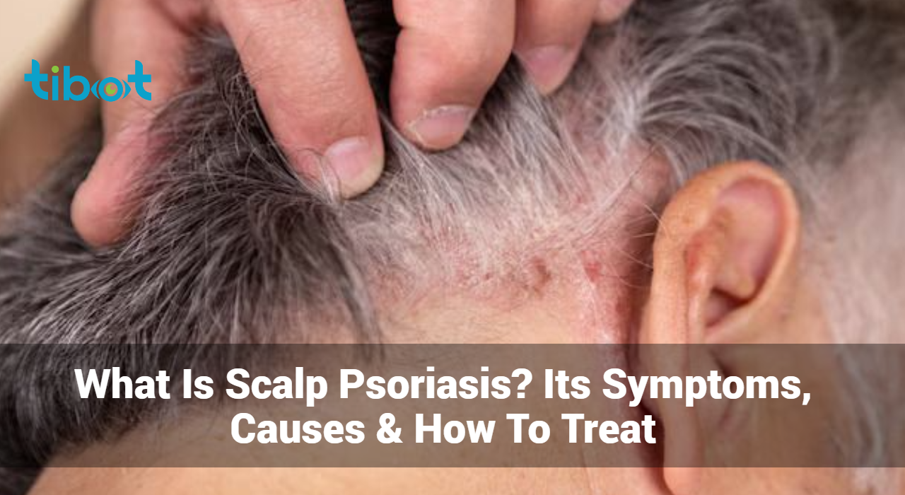 Scalp-Psoriasis